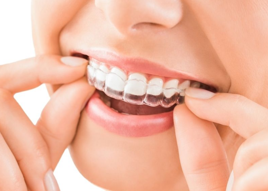 Dental-Straight My Teeth