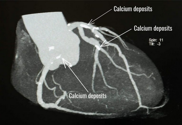CORONARY CT CALCIUM SCORE